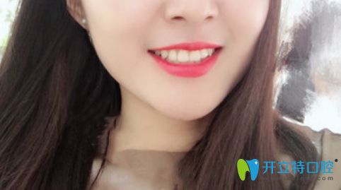 我戴隱形牙套一年效果圖