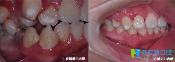 牙齒側(cè)面正畸前后對(duì)比效果圖