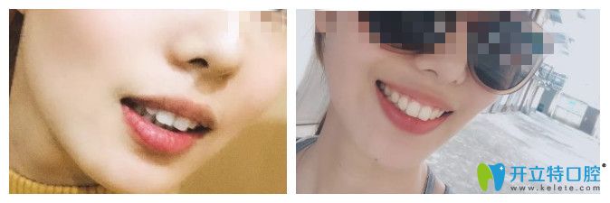 齙牙通過時(shí)代天使矯正<span style=