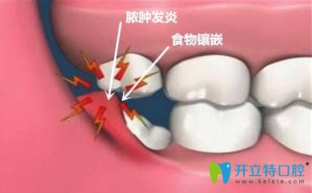 智齒冠周炎能自愈嗎