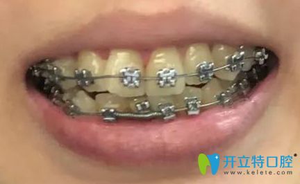 牙齒矯正3個(gè)月時(shí)的效果