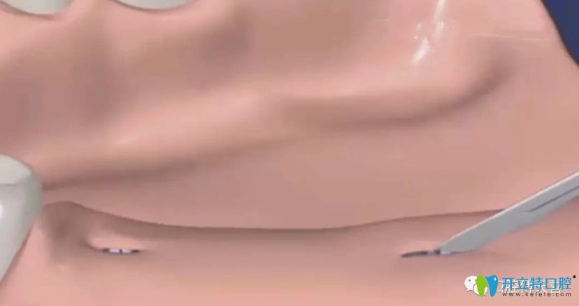 種植牙二期安裝愈合基臺疼嗎