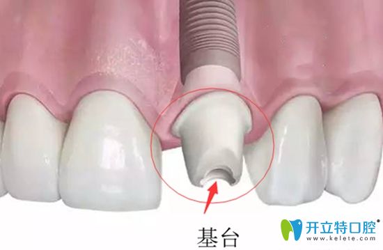 種植牙修復(fù)基臺(tái)