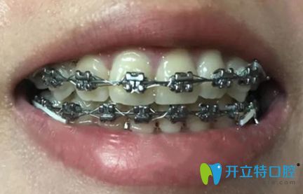 在深圳好佰年矯正牙齒9個(gè)月的效果圖