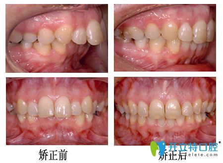 重慶牙博士口腔齙牙矯正案例