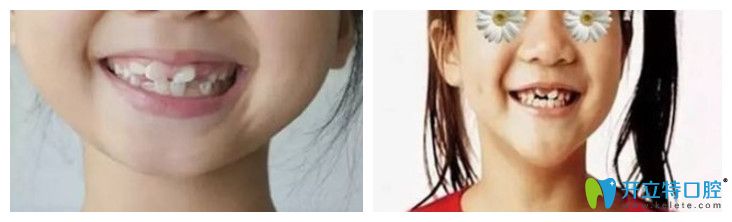 于淋醫(yī)生解答：換牙的時(shí)候舔牙牙齒會長歪，這是真的嗎？