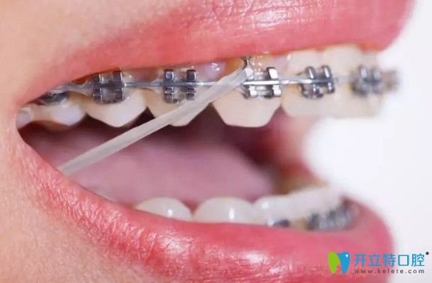 張慧貞醫(yī)生科普：正畸橡皮圈有什么作用？
