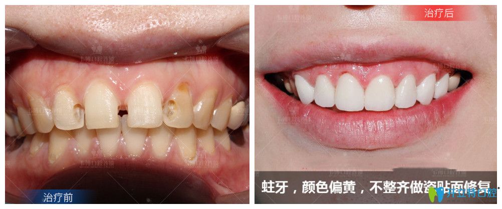 ↓蛀牙、顏色偏黃，不整齊做了瓷貼面修復(fù)后牙齒大變樣