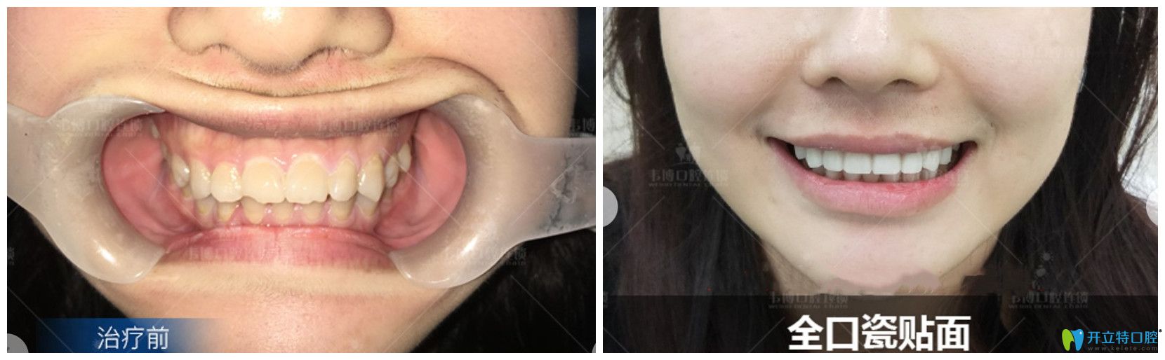 牙齒發(fā)黃，還缺損的小姐姐用瓷貼面來“武裝”牙齒