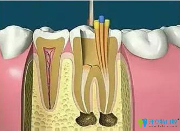 對根管進(jìn)行填充封閉整個根管系統(tǒng)