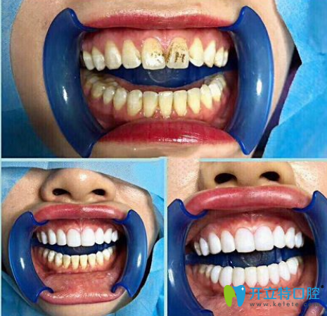 牙齒貼片前后對比