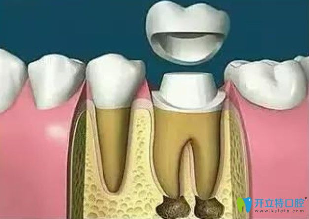 帶上牙冠保護(hù)壞牙完成修復(fù)
