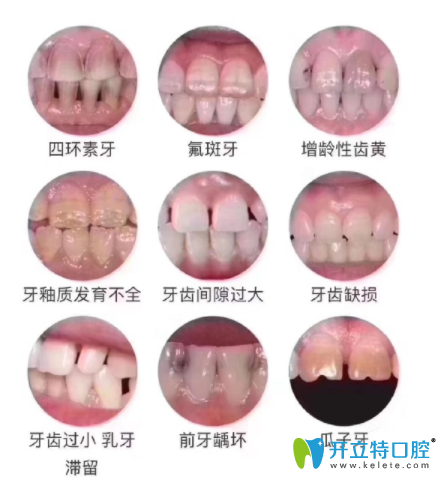 瓷貼面適應(yīng)癥