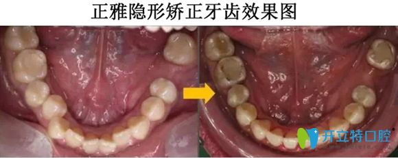 正雅隱形矯正牙齒的效果展示圖