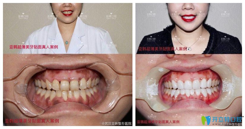 亞韓口腔黃牙做了超薄牙貼面修復(fù)案例對比圖
