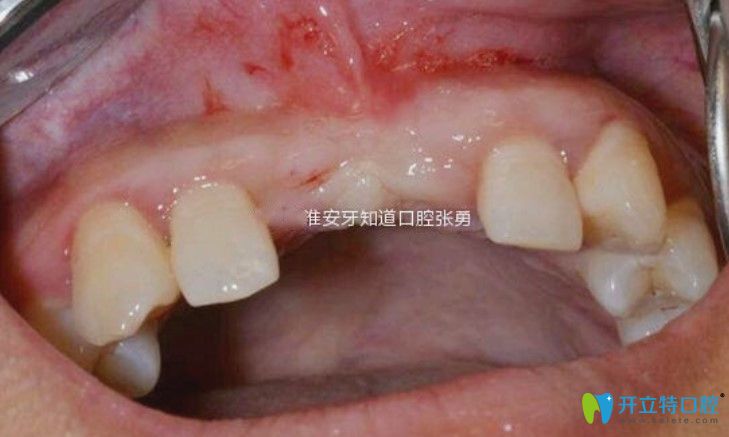 淮安哪里做種植牙好？顧客反饋淮安牙知道張勇種牙水平高