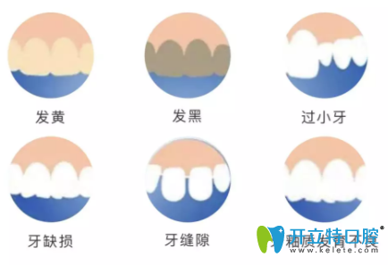 牙齒超薄貼面適應癥