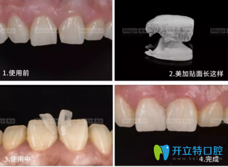 美加超薄貼面的壽命是多久？