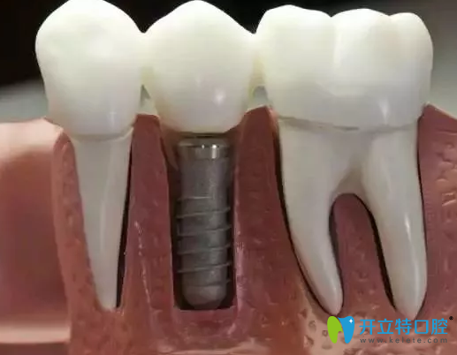 種牙需要多長時間