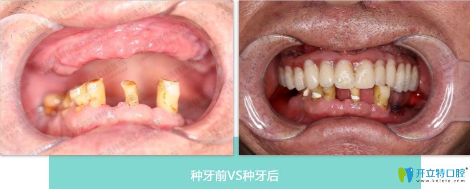 鄭琛醫(yī)生半口即刻負(fù)重種植案例效果分享