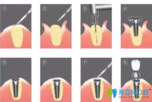 種植牙過程