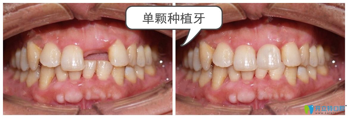 <!--<i data=20240703-sp></i>-->口腔單顆種植牙案例