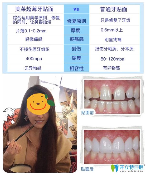 美萊超薄牙貼面你無悔的選擇，小姐姐來曬牙貼面后對比照