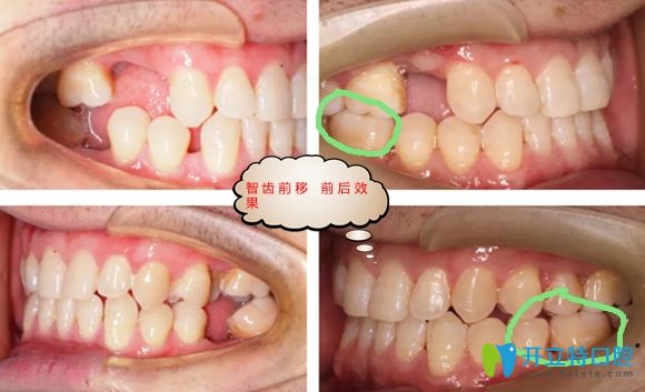 智齒前移代替種植牙的效果圖
