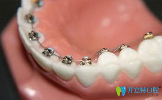 不影響美觀的舌側(cè)矯正技術(shù)