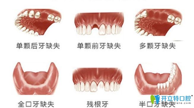 只要您的牙齒出現(xiàn)圖示問題都可申請種植牙補貼