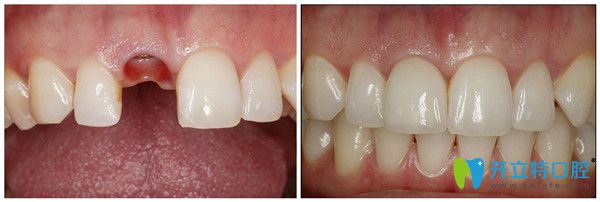 用德國生長因子種植牙技術做的牙齒