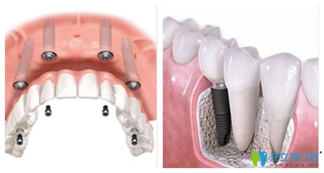廣州曙光口腔的種植牙技術(shù)