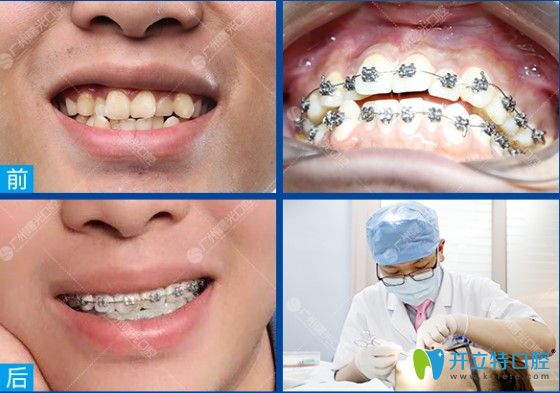 曙光牙科牙齒不齊矯正案例前后對比圖