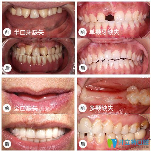 全口，半口種植牙真實(shí)案例及前后對(duì)比效果