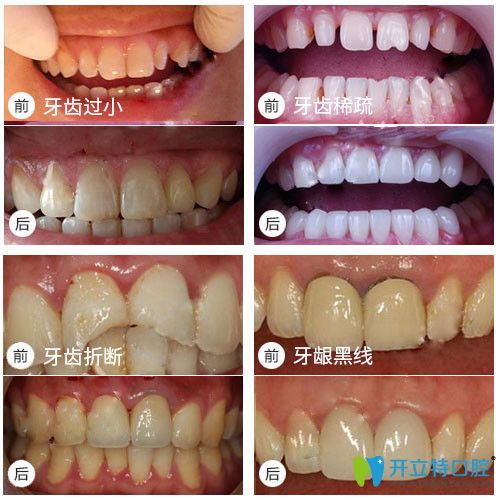 銘德口腔牙齒修復(fù)前后對(duì)比效果