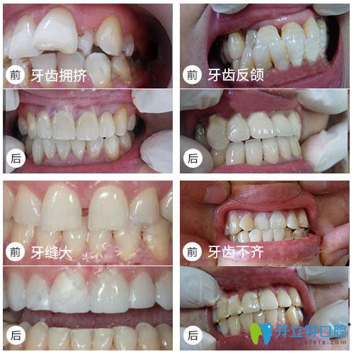 牙齒擁擠/牙齒不齊矯正等前后對(duì)比照