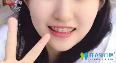 腔牙齒不齊矯正過程圖