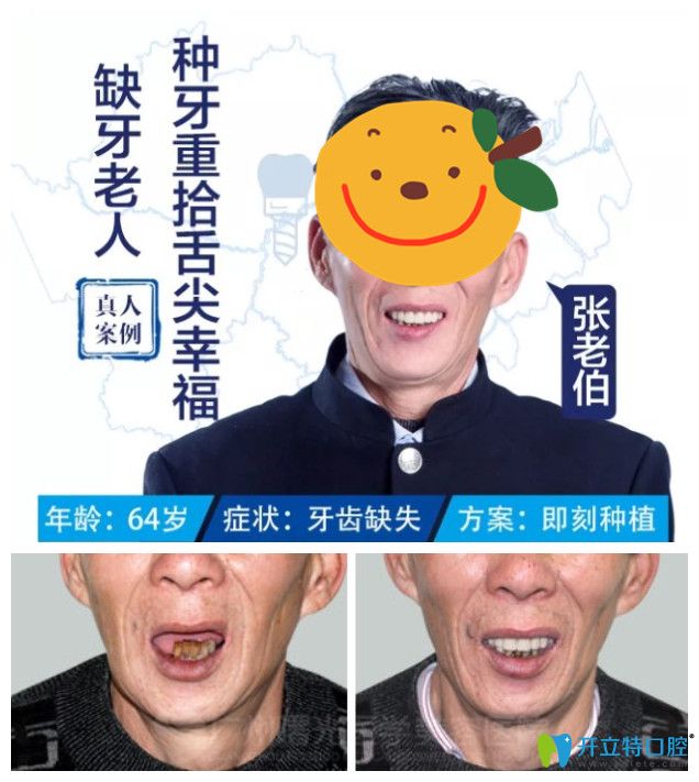 廣州曙光種植牙案例分享