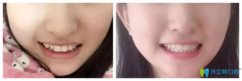 <!--<i data=20240703-sp></i>-->美樂口腔矯正牙齒前后對比圖