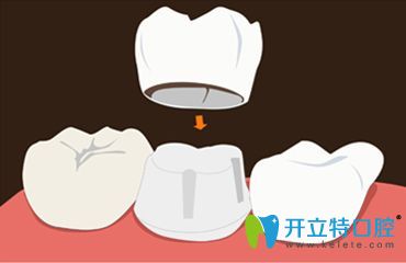 牙齒烤瓷冠圖片