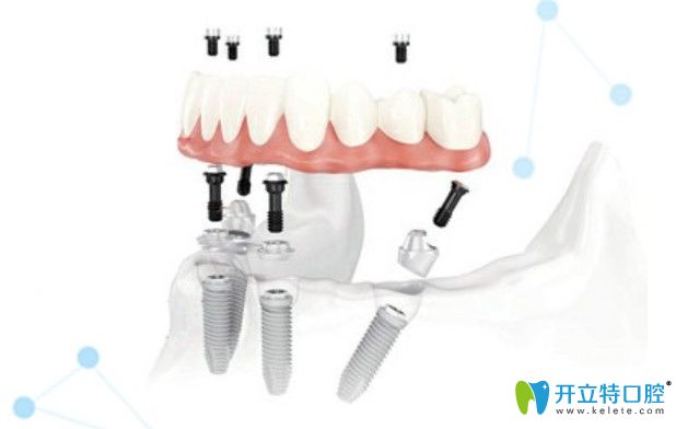 美奧口腔半口即刻種植牙優(yōu)勢(shì)