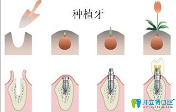 深圳僑諾口腔提醒大家種植牙后期也需我們好好維護(hù)