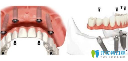 通過all-on-4即拔即種種植牙詳細步驟,來了解為啥不要植牙骨