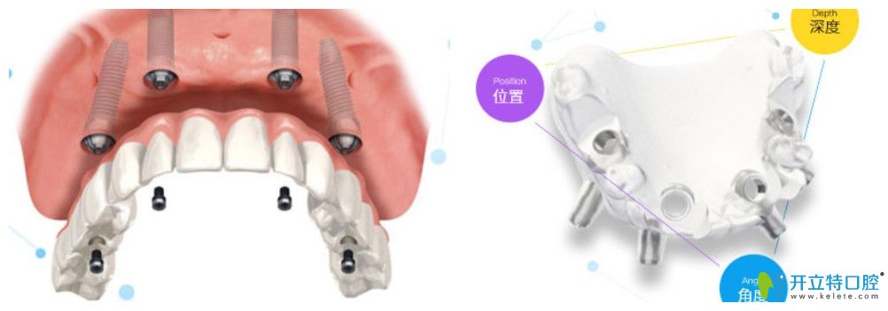 杭州美奧口腔的種植牙技術(shù)