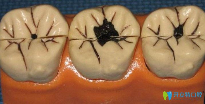 邵榮文解析牙齒上有小黑點是怎么回事
