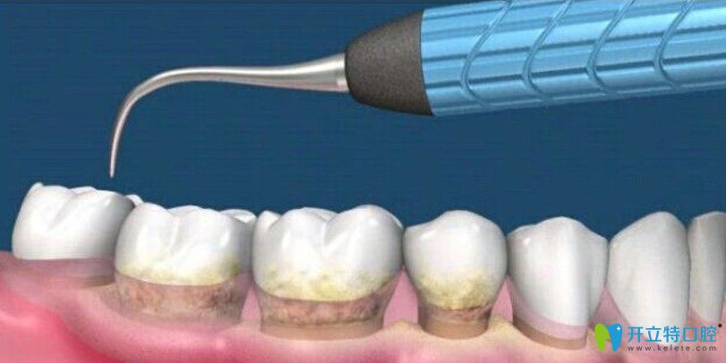 邵榮文解析牙齒上有小黑點該怎么辦