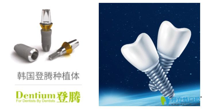 福州維樂口腔登騰種植牙價格