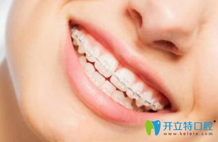 陶瓷半隱形矯正圖片