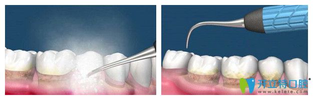 北極星口腔洗牙圖
