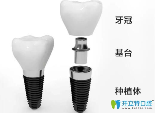 解析二段式種植體的組成及埋入式和非埋入式區(qū)別,種牙必看